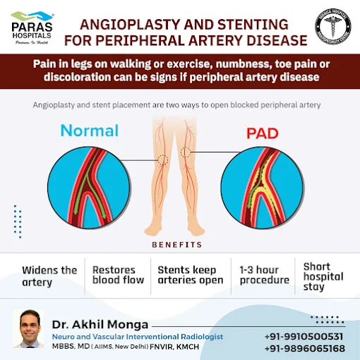 Angioplasty-and-stenting-for-PAD
