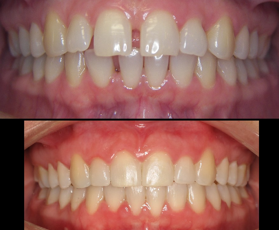 DIASTEMA-6-1
