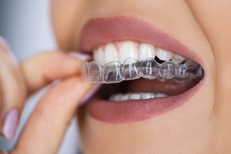 Invisible-Braces-Treatment