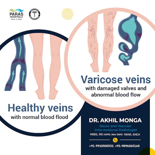 Varicose-veins