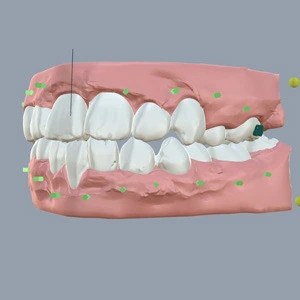 Cross-Bite-Teeth-after
