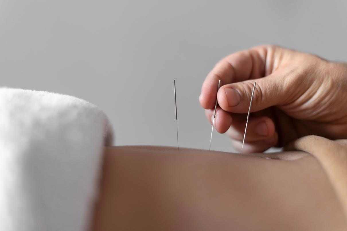 Dry-Needling