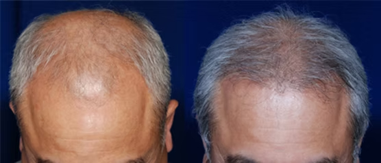 Hair-Transplant-New-York-City-4