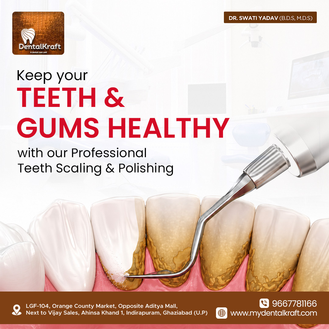 teeth-whitening-treatment-in-Indirapuram