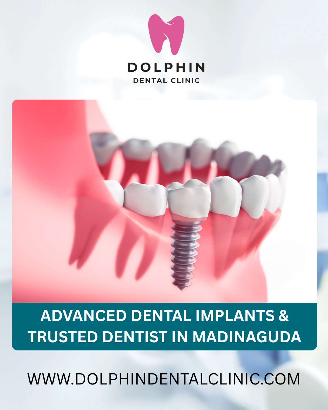 Advanced-Dental-Implants-Trusted-Dentist-in-Madinaguda