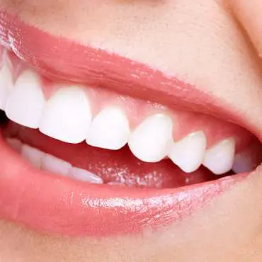 Smile-Makeover