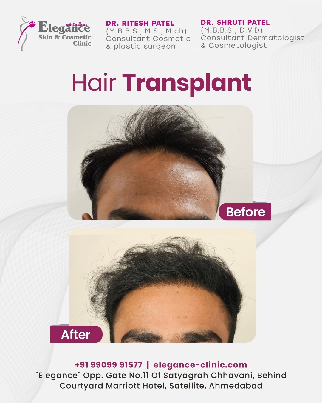 Best-hair-transplant-surgery-in-Satellite