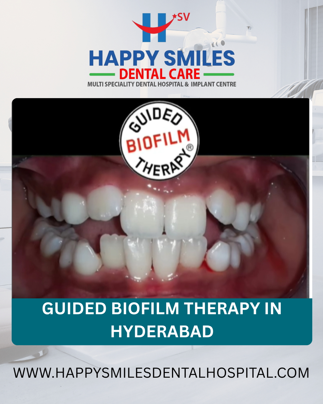 Guided-Biofilm-Therapy-in-Hyderabad