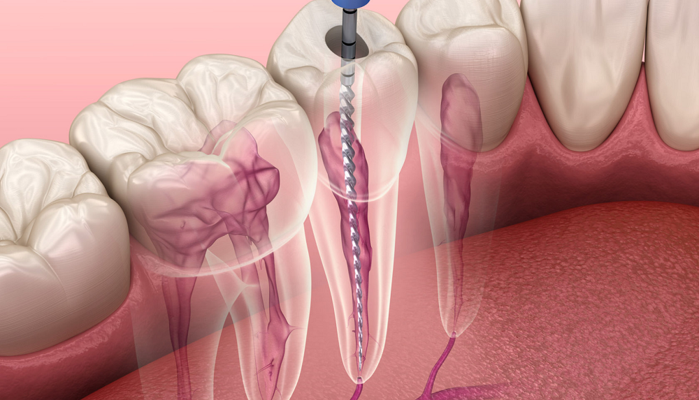 Root-Canal-Treatment-and-Single-Sitting-RCT-in-Thane