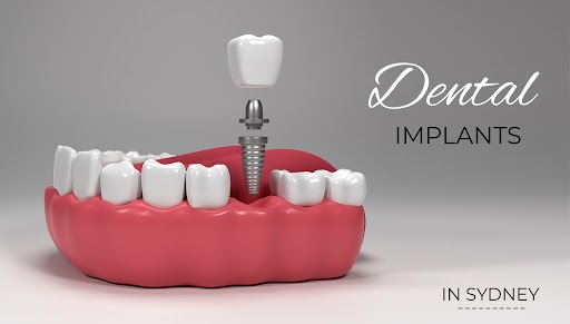 dental-implants-in-sydney
