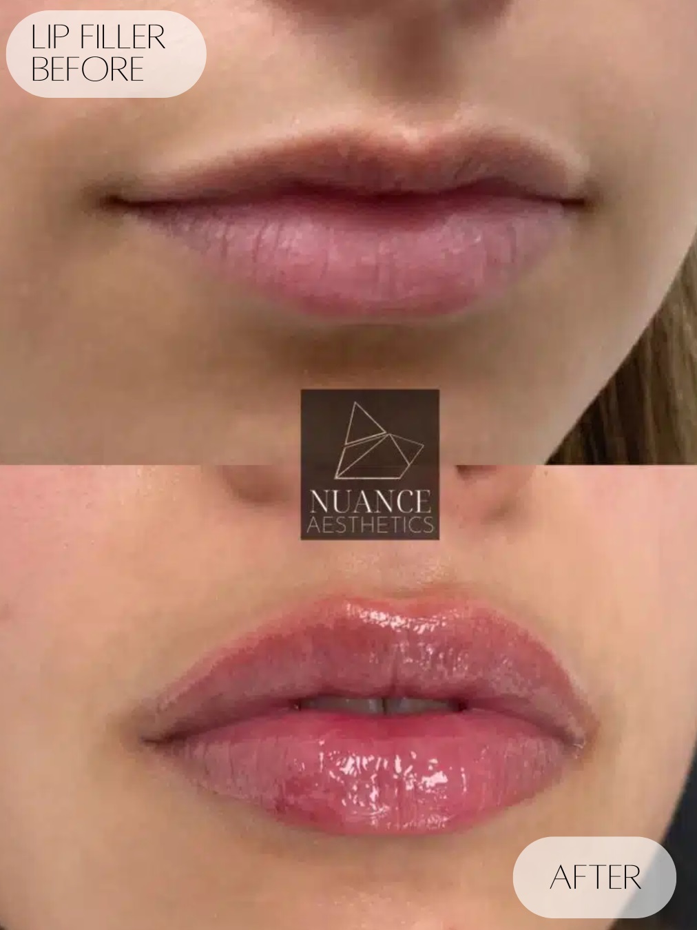 CoolSculpting-SLC-UT
