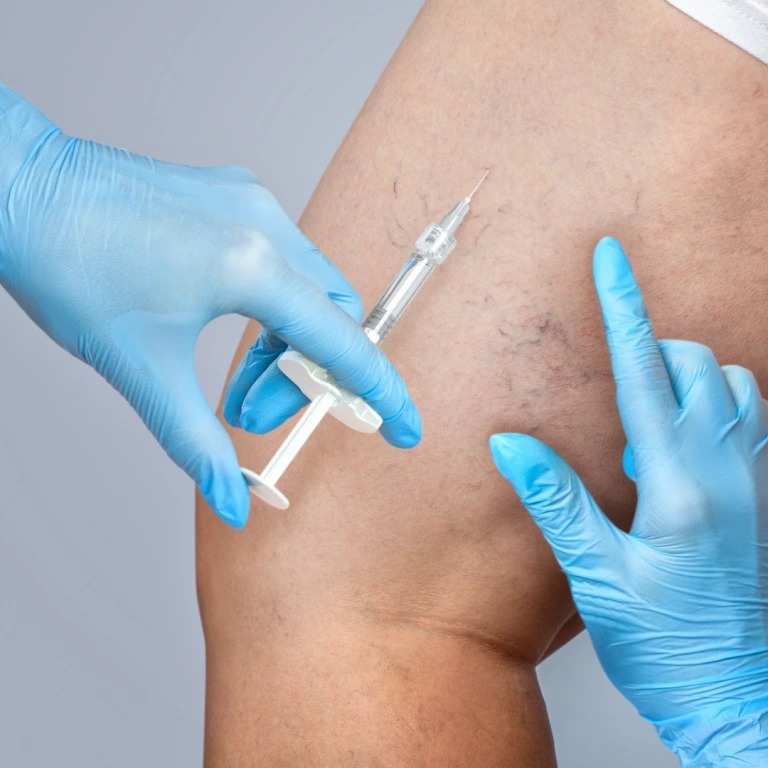 imgi_8_Compounded-Sclerotherapy_-768×768-1_compressed