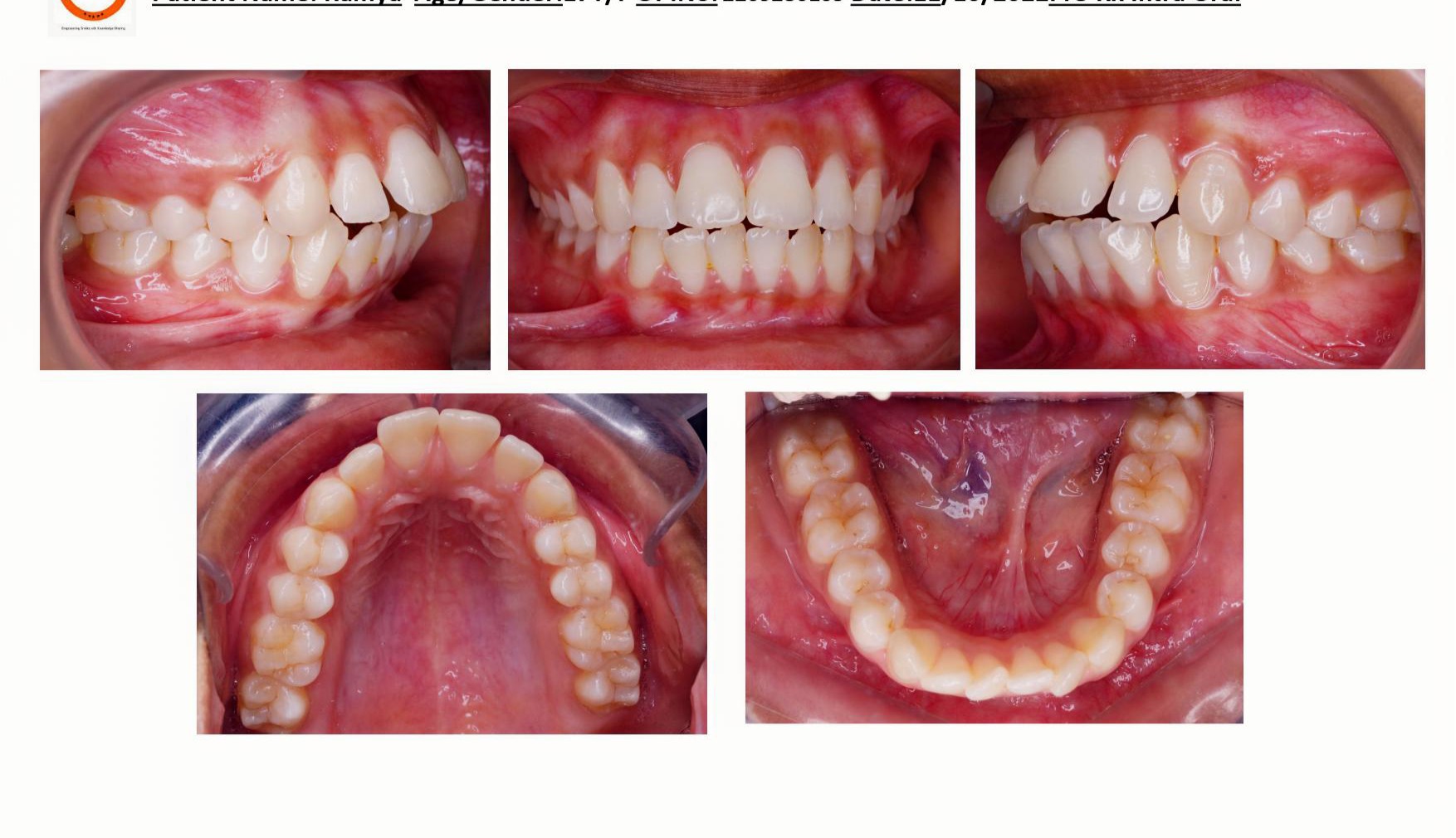 invisalign-gachibowli-hyderabad-smiles-by-sneha-clear-aligners-001.jpg