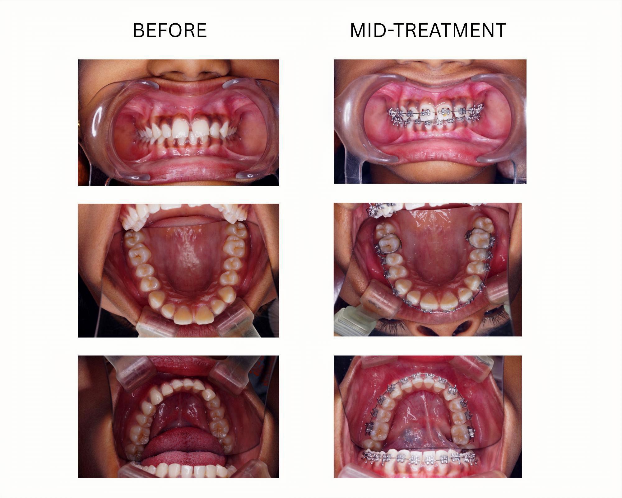invisalign-provider-gachibowli-hyderabad-smiles-by-sneha-021