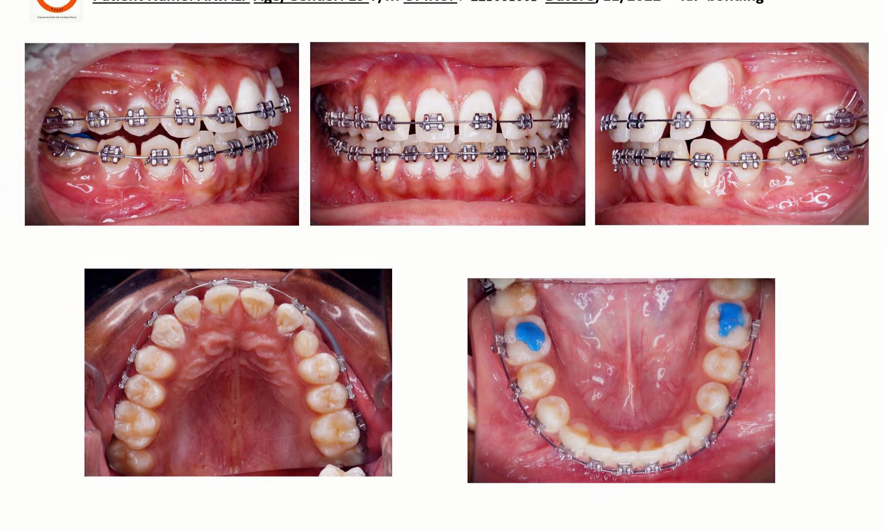 top-invisalign-provider-gachibowli-hyderabad-smiles-by-sneha-011.jpg