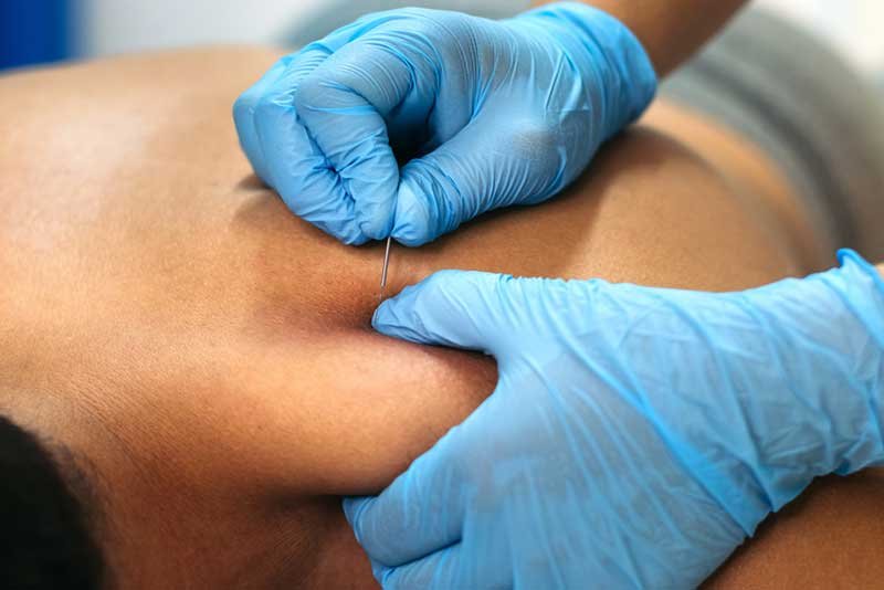 Dry-Needling-Nyc