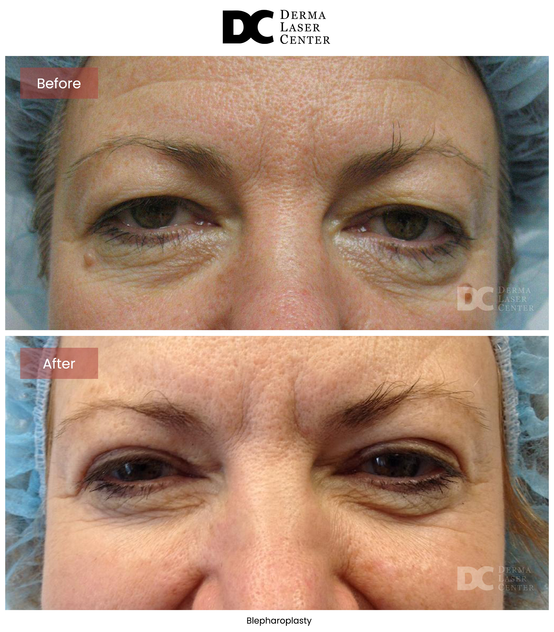 BA-Blepharoplasty-Image-10-V1
