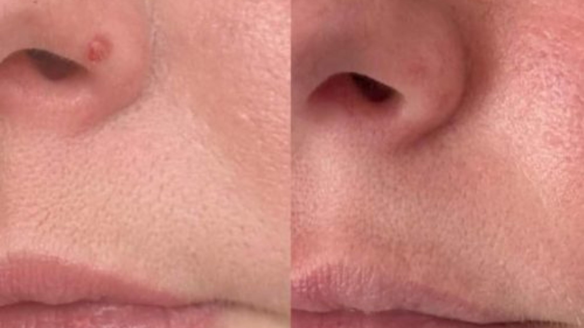 Fibrous-Papules-Removal-