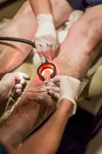 imgi_7_Scelerotherapy_Illinois-Vein-Specialists-200×300-1
