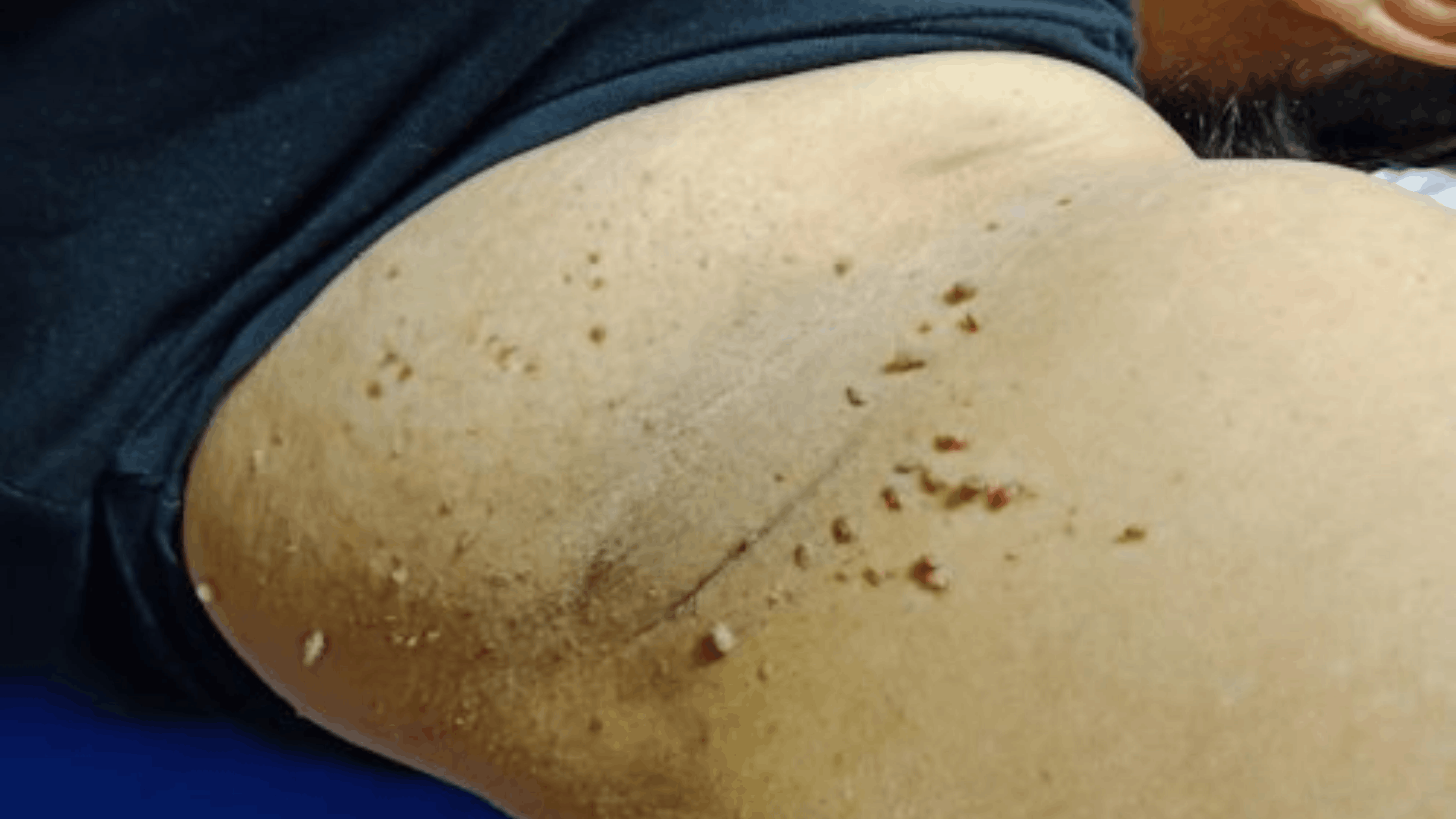 sking-tag-removal-1